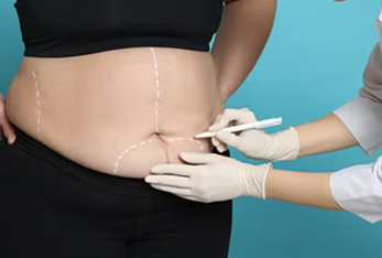 Liposuction body contouring procedure